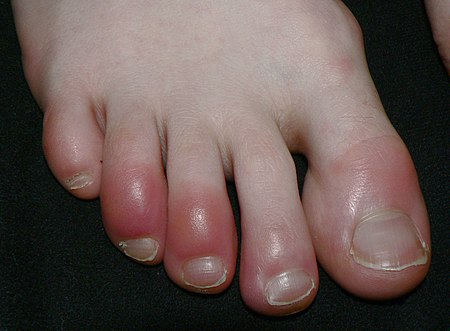 chilblains